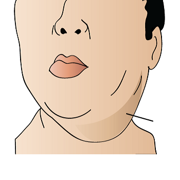 mumps mumps