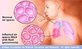 pneumonia pneumonia