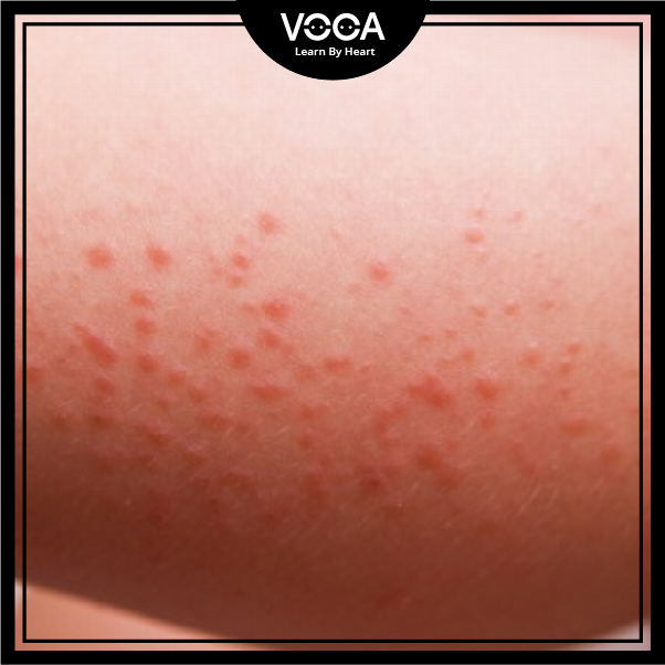 rash rash