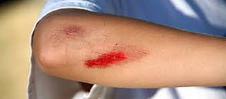 wound wound