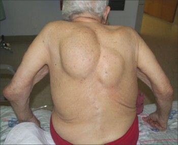 THE OLD MAN WITH A BUMP